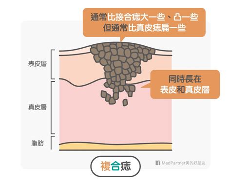 點痣 流血|點痣筆一擦，黑痣就掉了？醫師冷笑科科兩聲：「點痣。